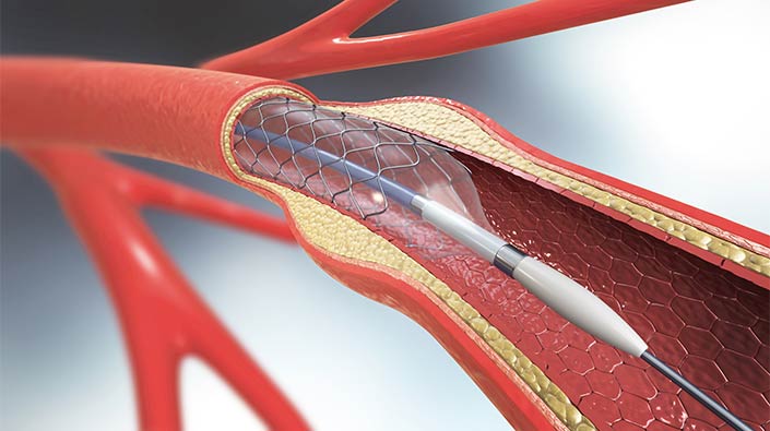 Interventional Cardiology