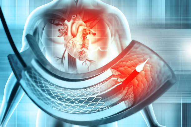 Interventional Neuroradiology