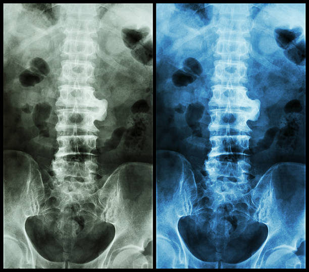 Spondylitis