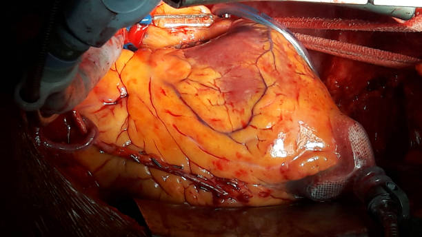 Coronary Artery Bypass Graft Surgery (CABG)