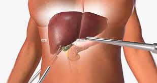 Laparoscopic Cholecystectomy