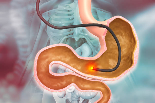 Upper Gastrointestinal (UGI) Endoscopy