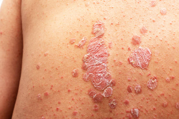 Psoriasis