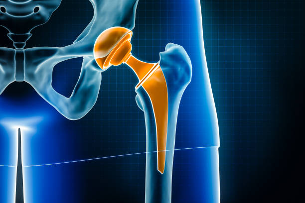 Total Hip Replacement Surgery