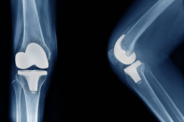 Joint Replacement