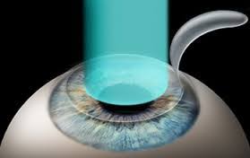 Cornea and Refractive Surgery