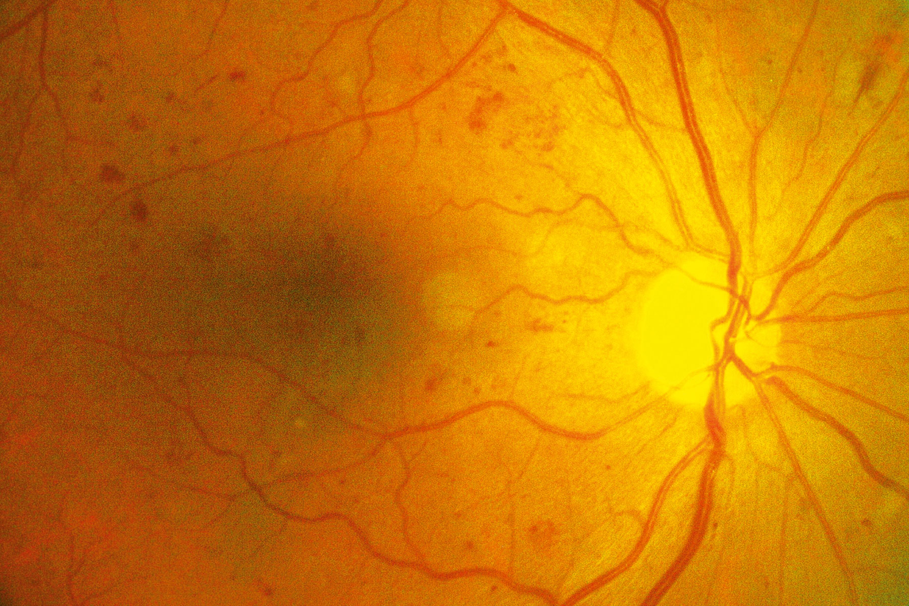 Diabetic Retinopathy